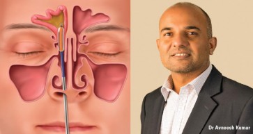 Help for Sinus Sufferers