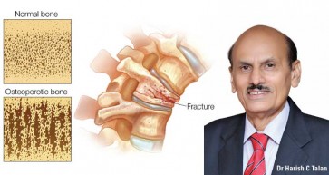 Bone Health Lifestyle Tips